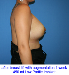 plastic-surgery-breast-lift-augmentation